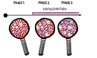 Schematische Abbildung der Phasen der CML Erkrankungen