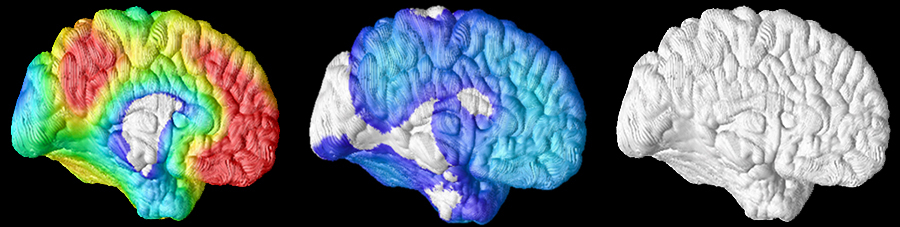 Amyloid-Ablagerungen
