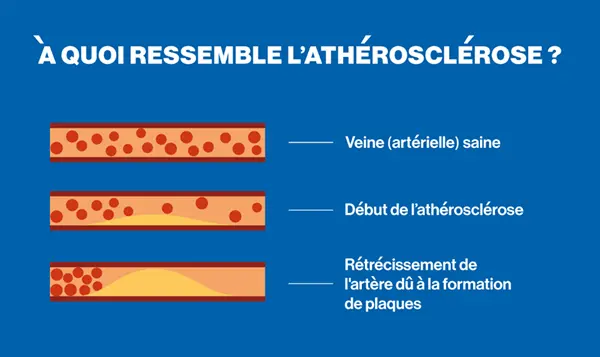 Infographic maladies cardiovasculaires
