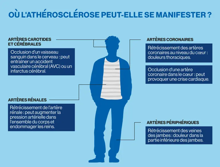 Infographic maladies cardiovasculaires