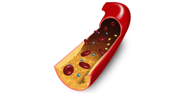 3D Illustration von Fettablagerungen in Arterien/ Illustration 3D des dépôts de graisse dans les artères