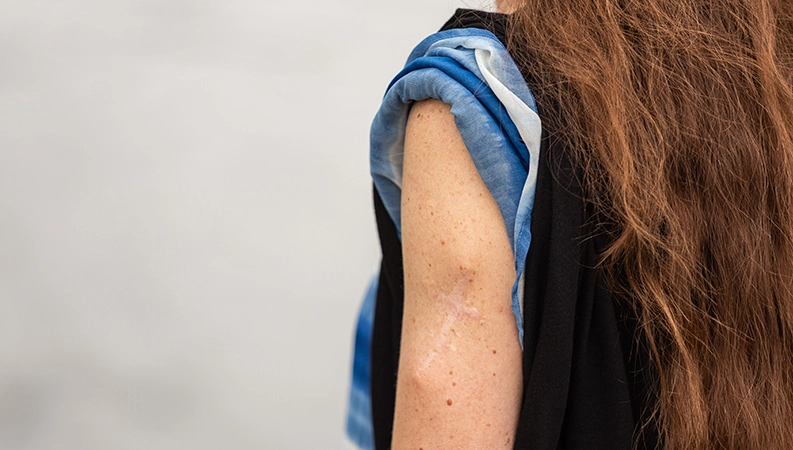 Spuren eines potenziell lebensrettenden Eingriffs: Natascha steht zu ihren Narben.