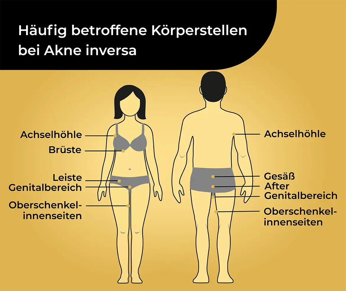 Häufig betroffene Körperstellen bei Acne inversa