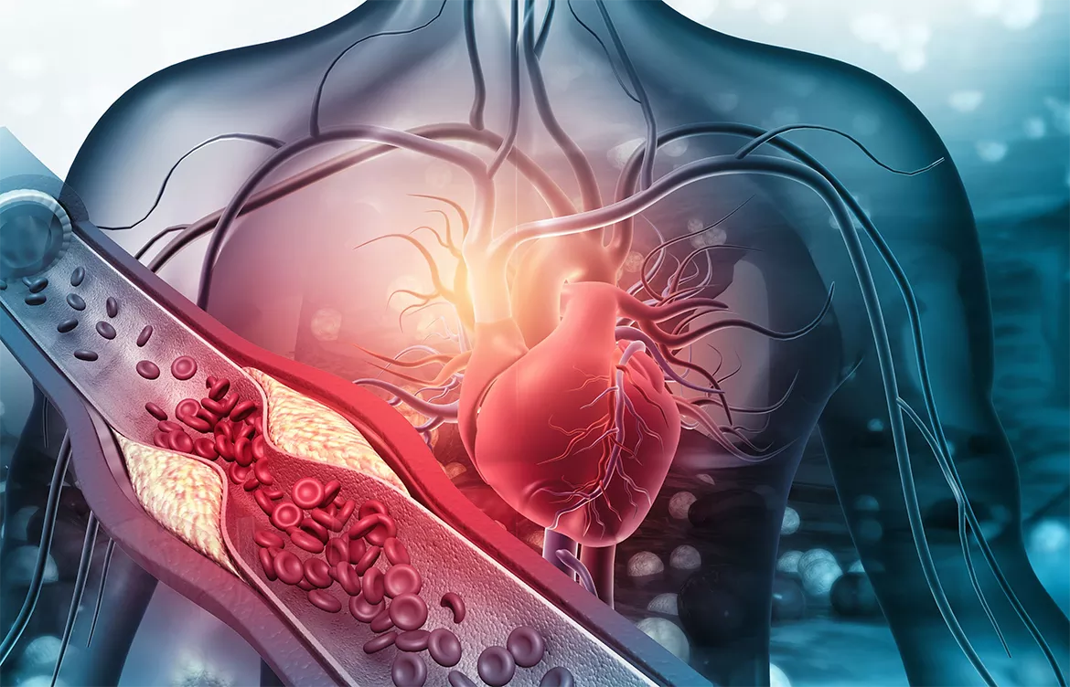 Schematische Darstellung des menschlichen Gefäßsystems. Im Vordergrund eine vergrößert dargestellte Arterie, die aufgrund einer Fettablagerung verengt ist.