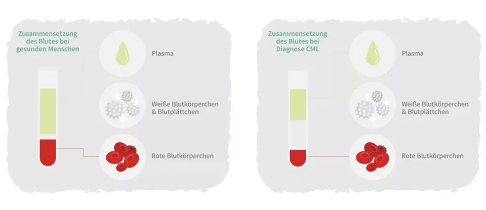 Unterschiede bei der Zusammensetzung des Blutes bei CML-Betroffenen und gesunden Menschen.