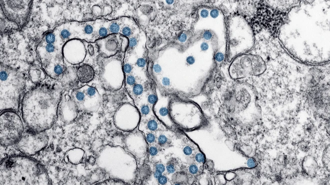 Transmission electron microscopic image of an isolate from a case of COVID-19 Transmission electron microscopic image of an isolate from a case of COVID-19