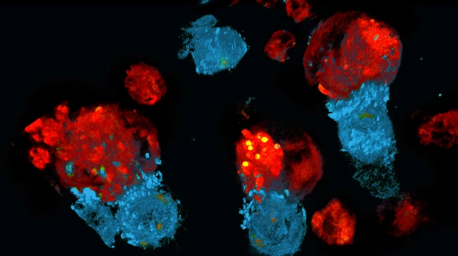 CART attacking target tumor cell