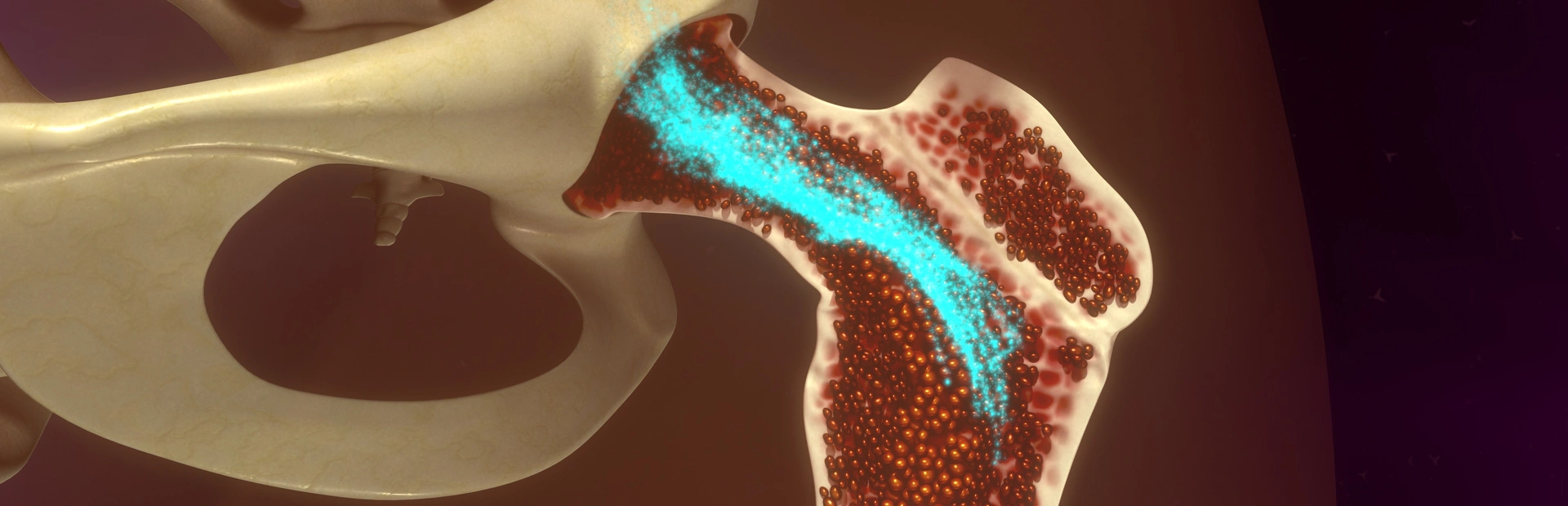 Ilustración de la mielofibrosis