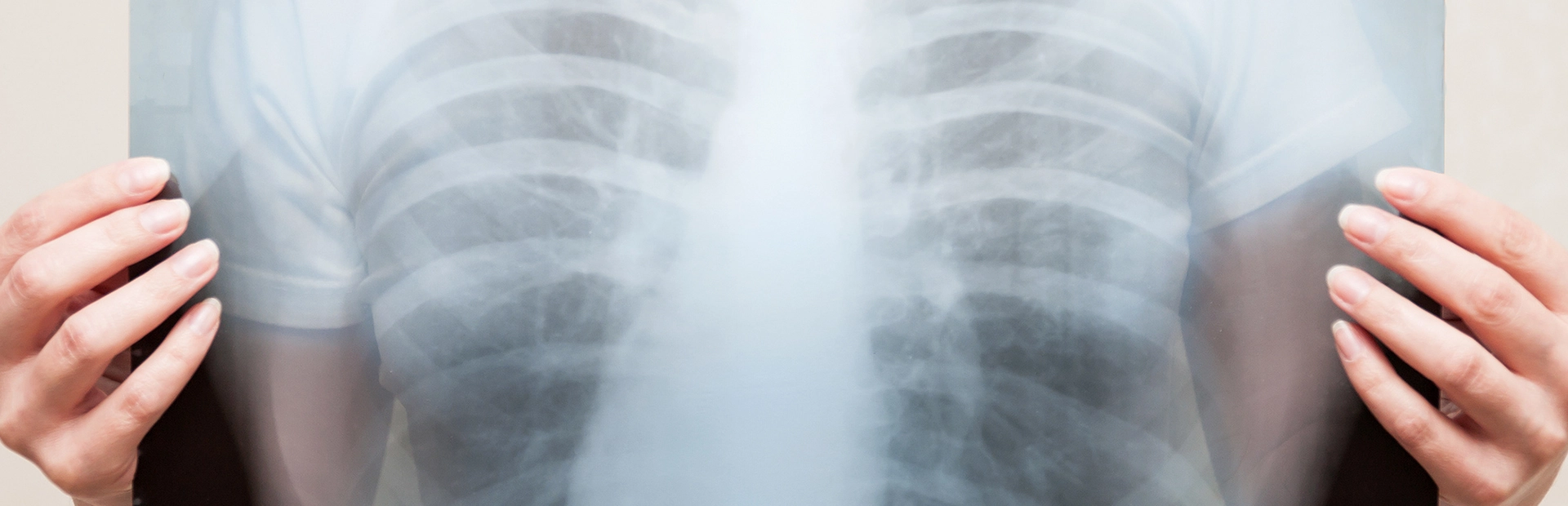 persona sujetando una radiografía de su caja torácica