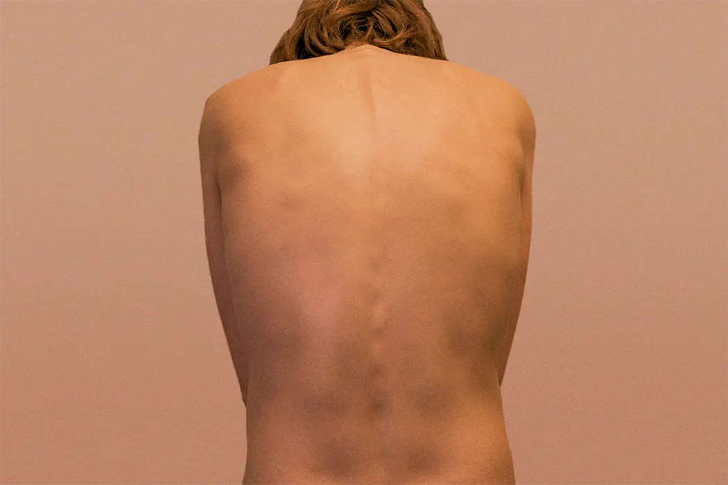 Aksiaalinen spondylartriitti