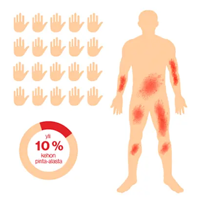 Vaikea psoriasis