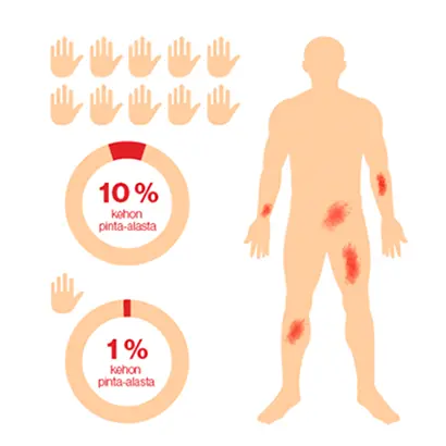 Psoriasiksen laajuuden arviointi