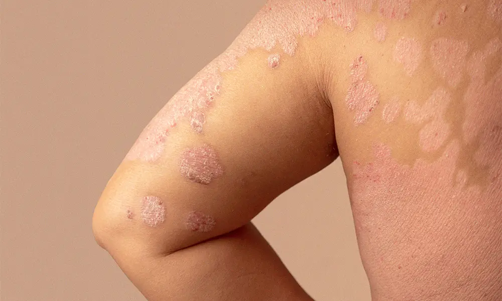 psoriasis käsivarressa