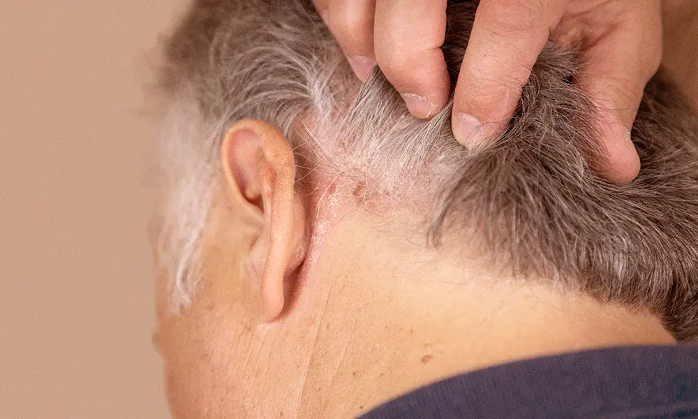 psoriasis päänahassa