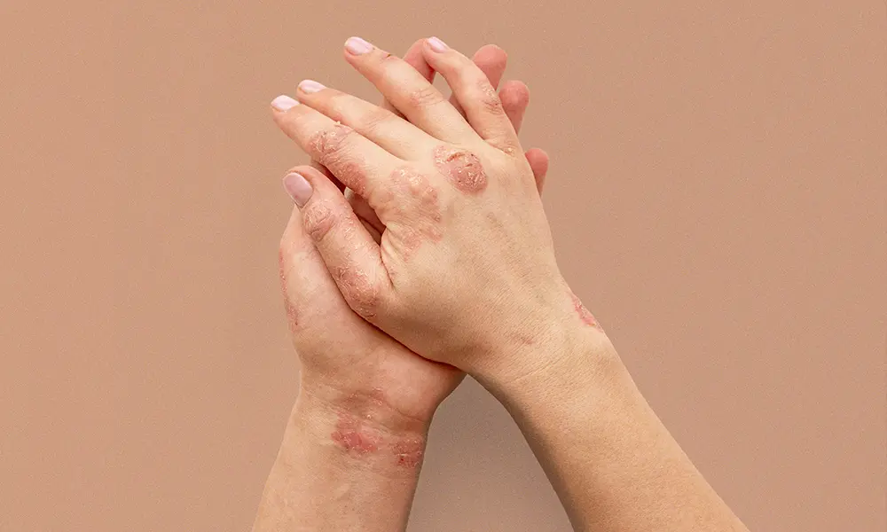psoriasis käsissä