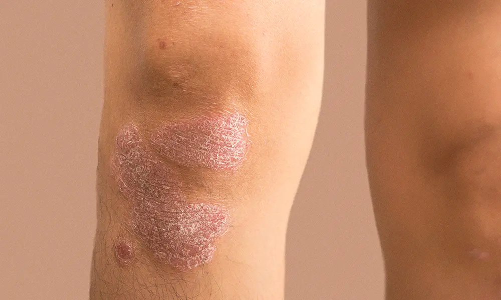 psoriasis polvessa