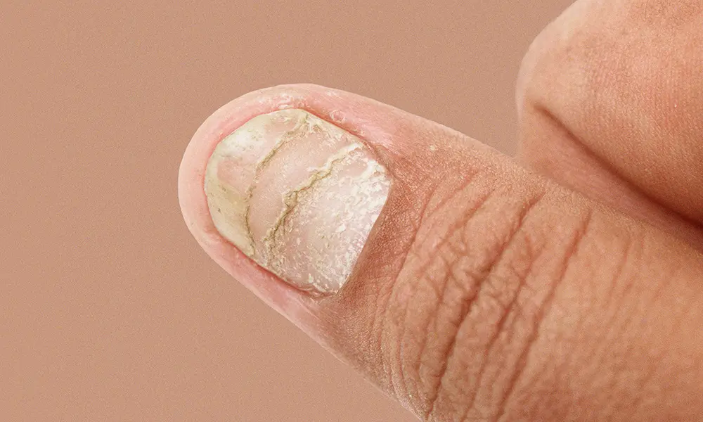 psoriasis kynnessä