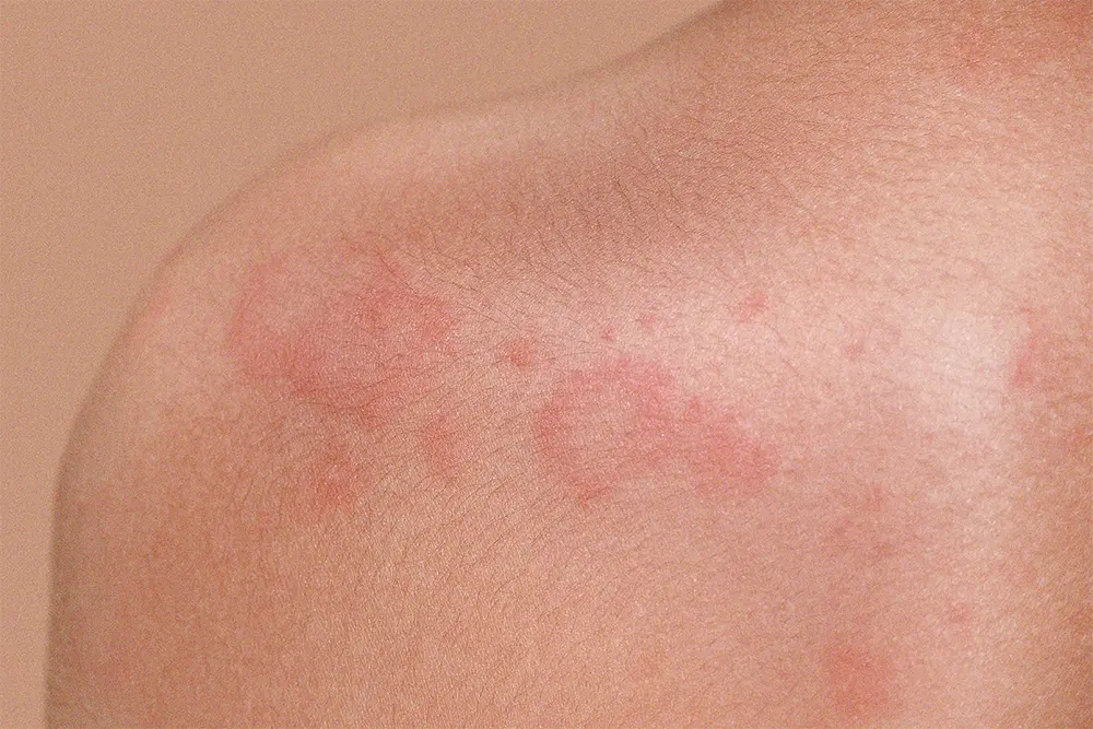 Urtikaria oire