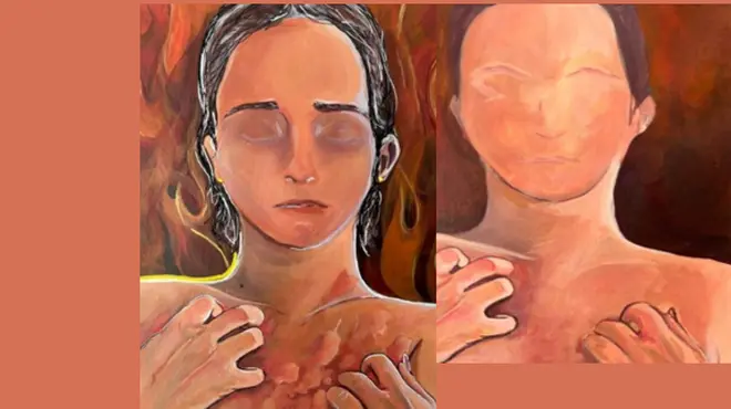 Share your experience of living with Chronic Spontaneous Urticaria (CSU) Share your experience of living with Chronic Spontaneous Urticaria (CSU)