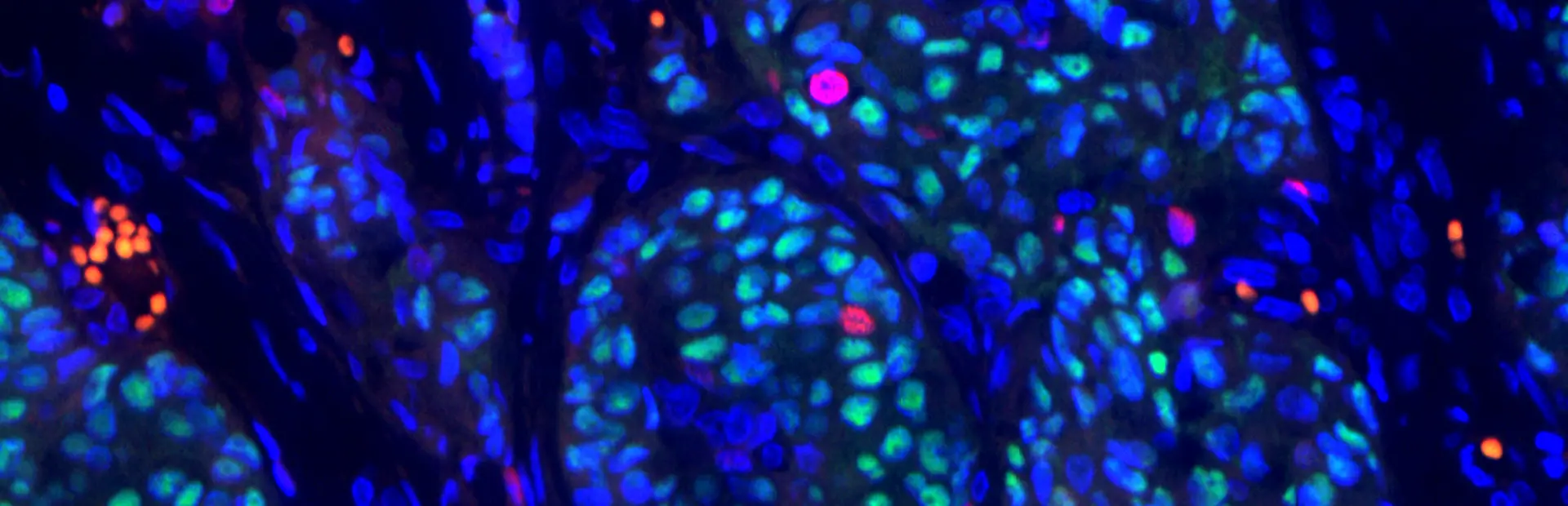 Painted cellular image of breast cancer