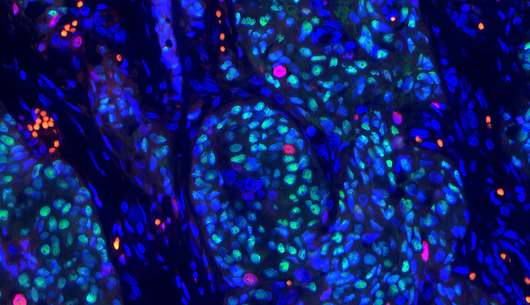 Breast cancer cells
