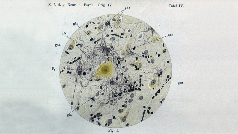 The earliest evidence of amyloid plaques.
