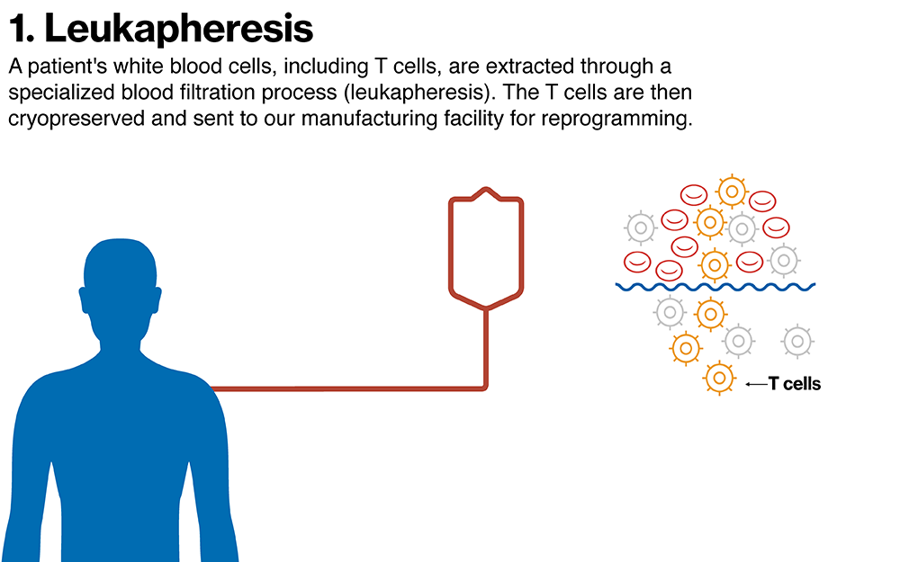 Leukapheresis