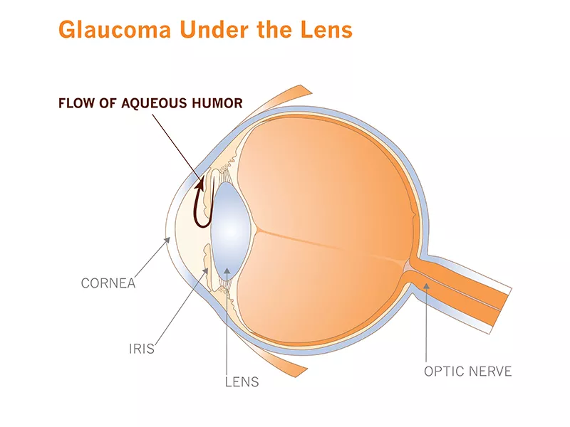 Glaucoma under the lens