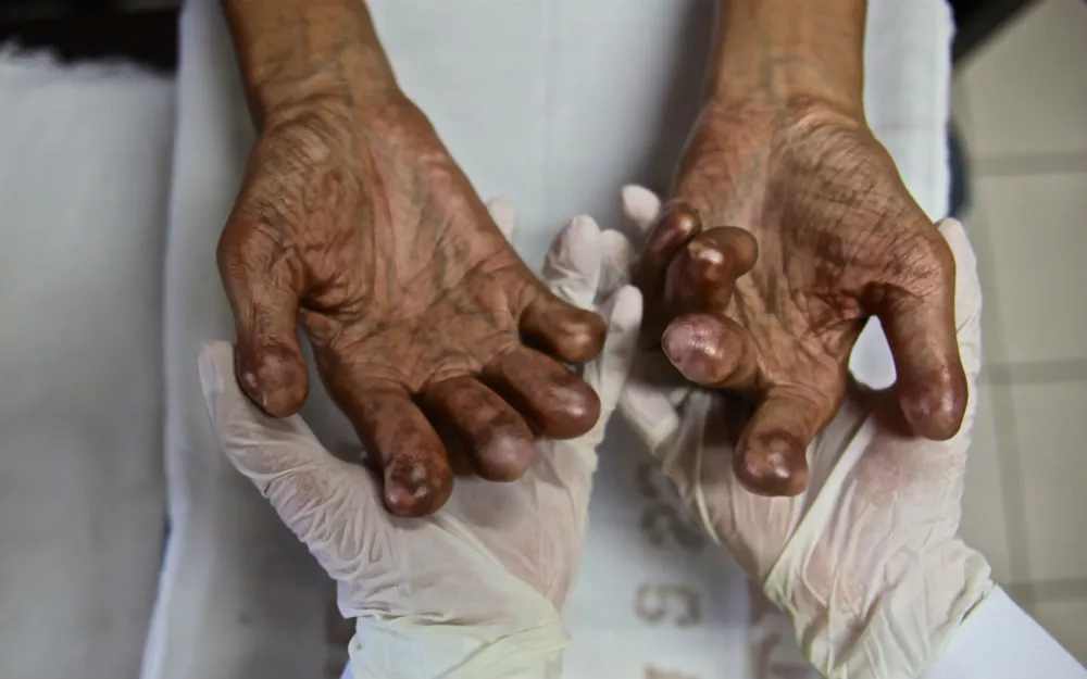 Leprosy can cause deformity in patients as a result of nerve damage