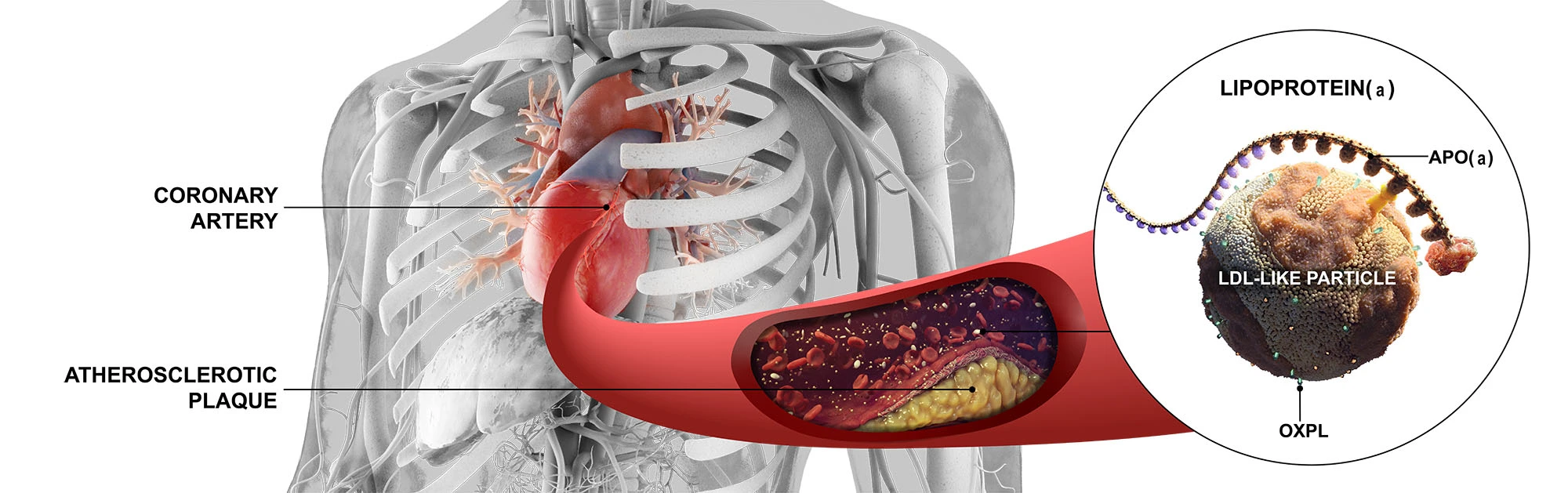 Visualization of the impact of Lp(a)
