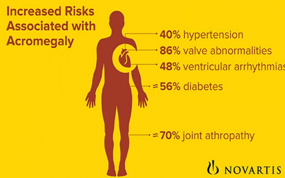 Acromegaly infographic