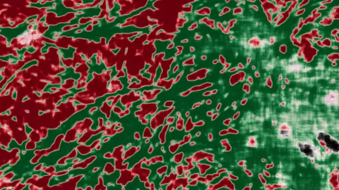 AI image overlay of pathology image