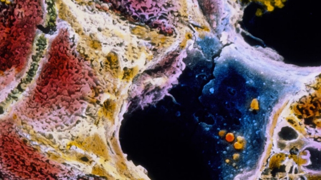 Scar tissue (light brown) has invaded this lobule of a liver affected by cirrhosis. Scar tissue (light brown) has invaded this lobule of a liver affected by cirrhosis. SEM image by Motta & Fujita/Science Photo Library