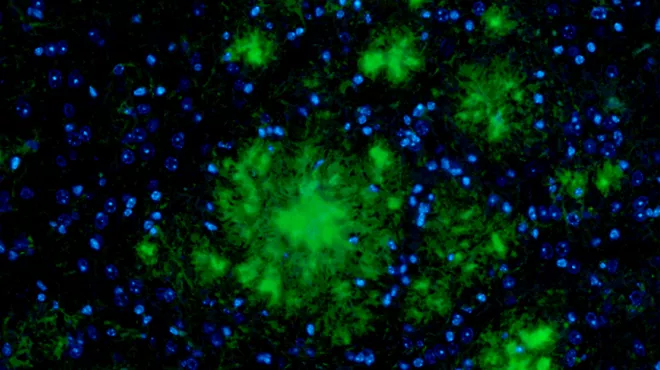 Amyloid plaques (green) in brain tissue.