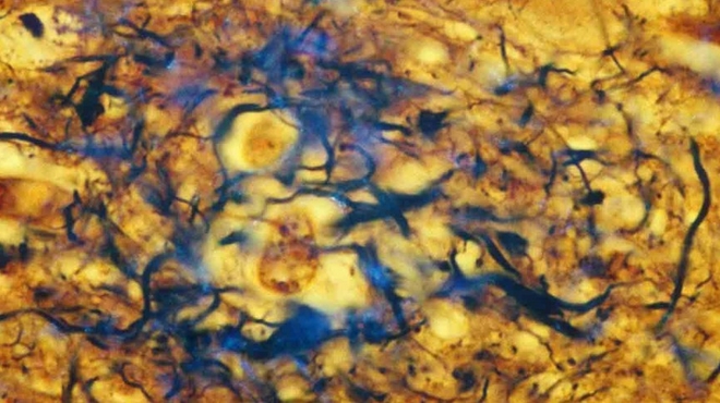 Stopping Alzheimer's disease before it starts Stopping Alzheimer's disease before it starts