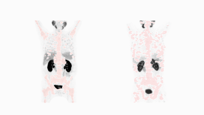 Unveiling cancer with nuclear medicine