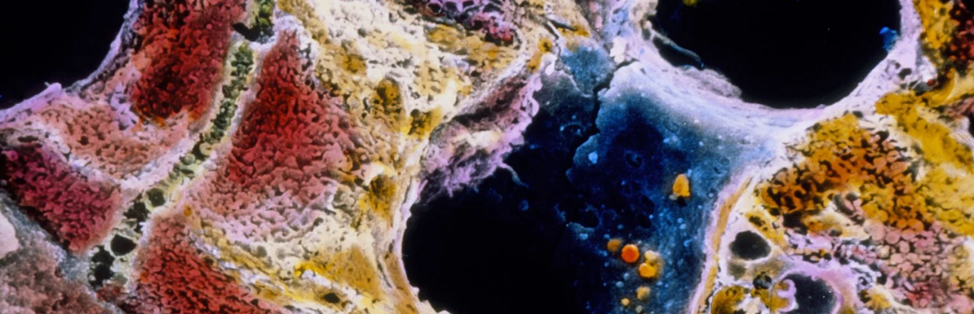 Scar tissue (light brown) has invaded this lobule of a liver affected by cirrhosis. SEM image by Motta & Fujita/Science Photo Library