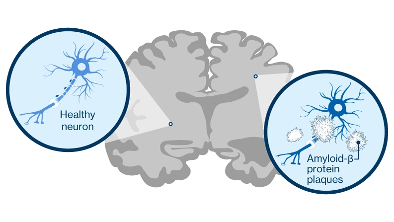 Amyloid plaques in the brain