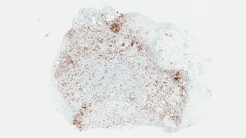 IL-1 beta molecules (stained brown) cluster around tumors and act like a smoke screen for cancer. 