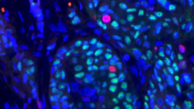 Painted cellular image of breast cancer