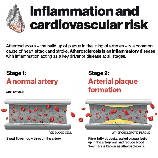 Atherosclerosis – the build up of plaque in the lining of arteries – is a common cause of heart attack and stroke