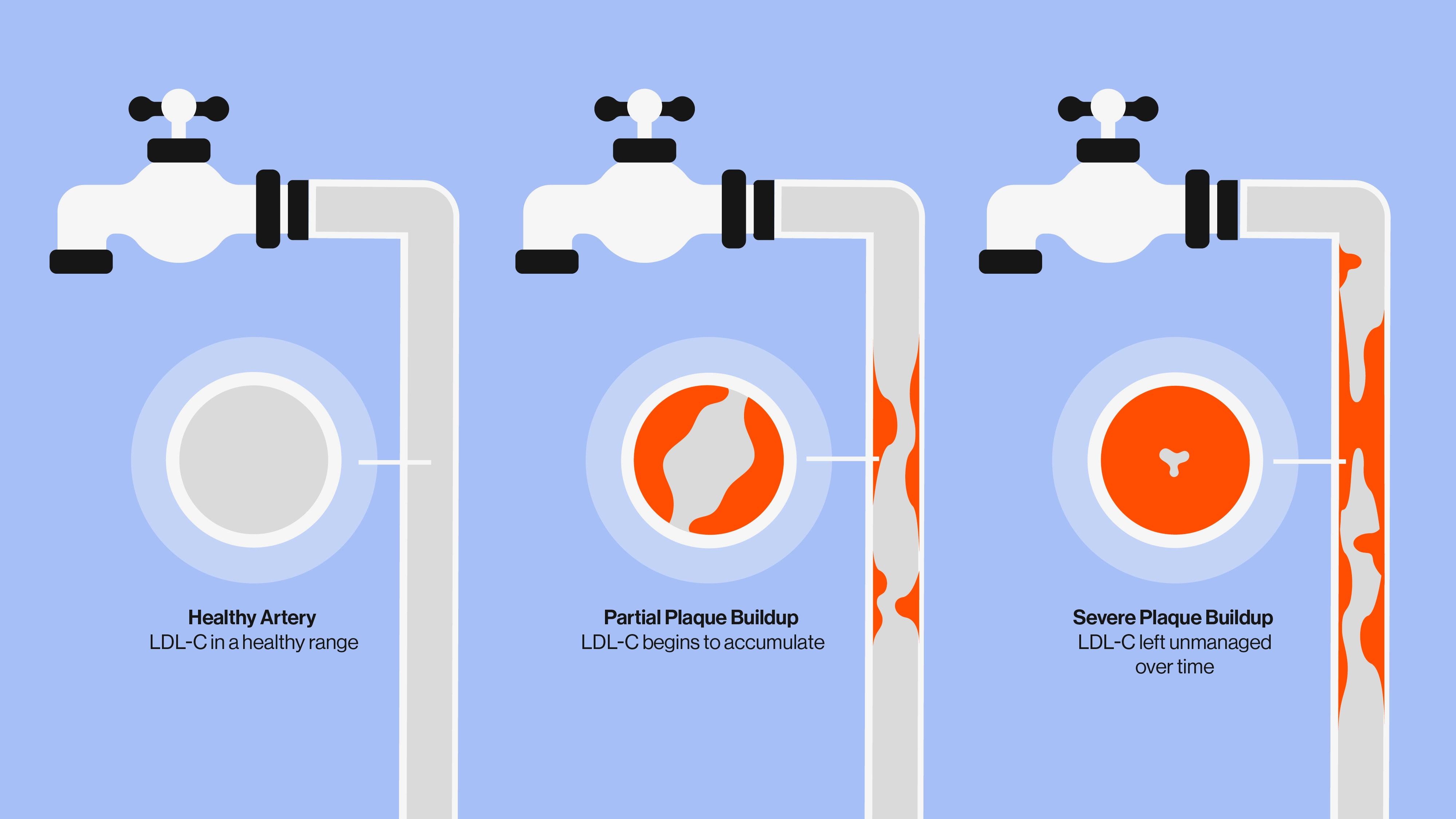 An illustration that shows the difference between healthy arteries and some with various stages of plaque buildup. 