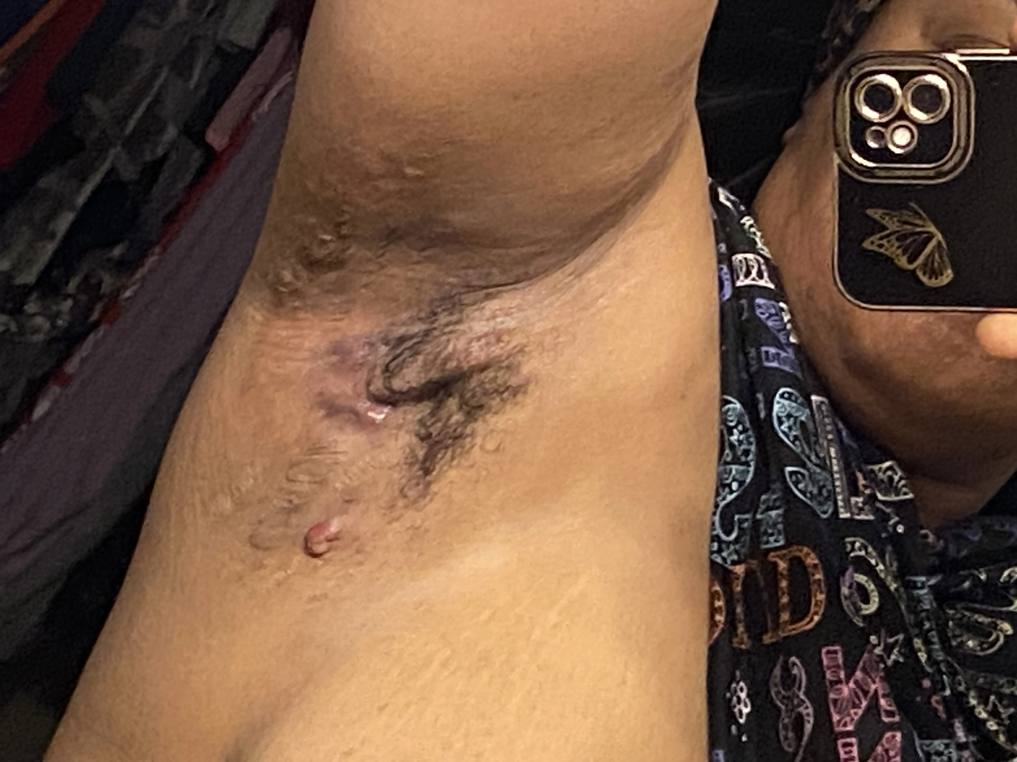 Close-up of hidradenitis suppurativa lesions in a patient’s underarm.