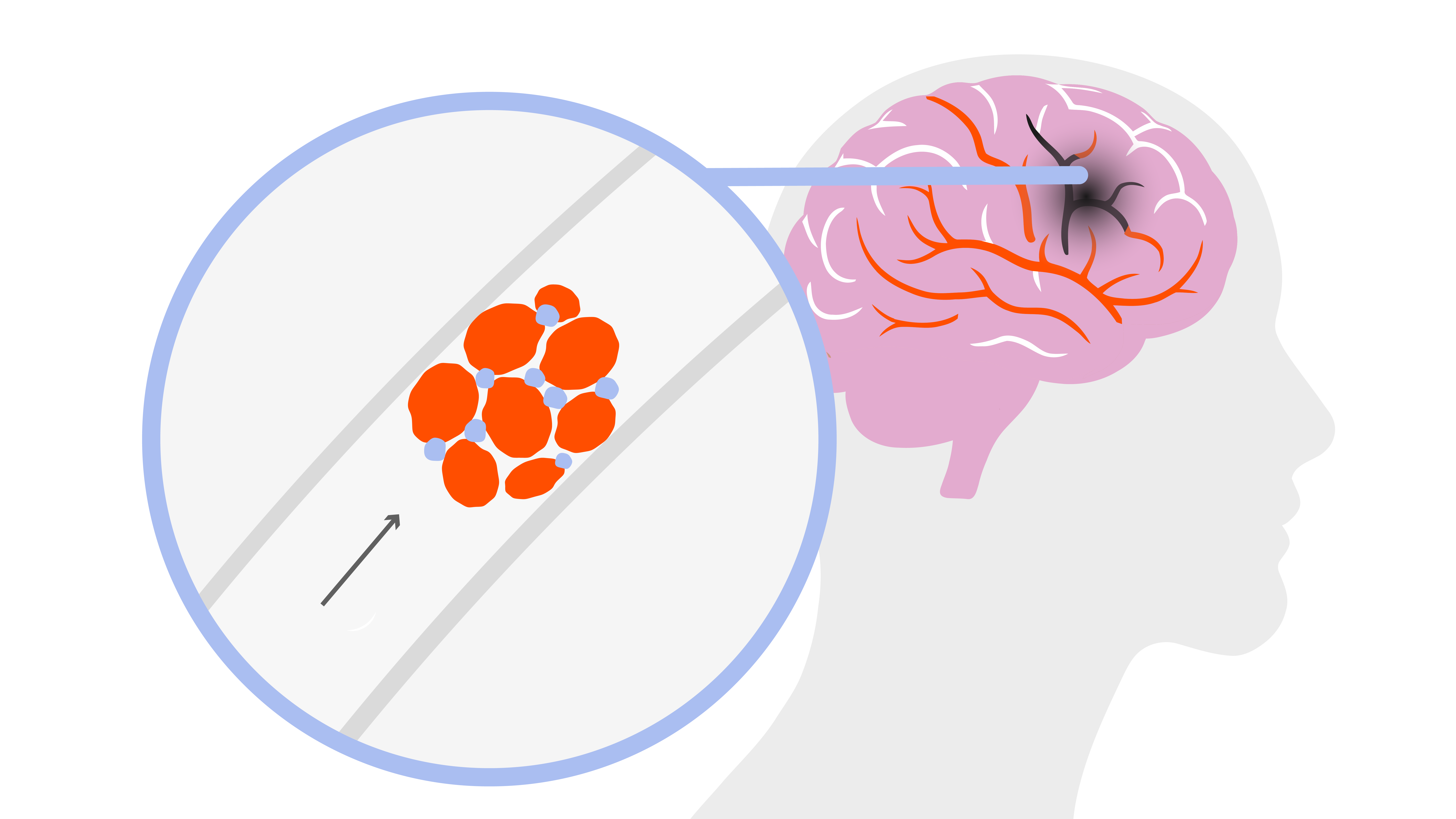 AFib rhythm clotting