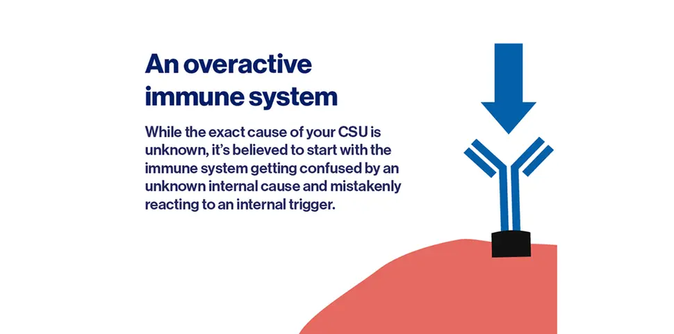 One potential cause of CSU: an overactive immune system - 1