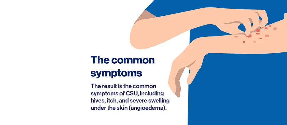 One potential cause of CSU: an overactive immune system - 4