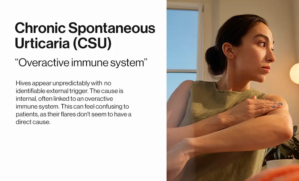 Chronic Spontaneous vs. Inducible Urticaria: What Is the Difference? *Patient Portrayal