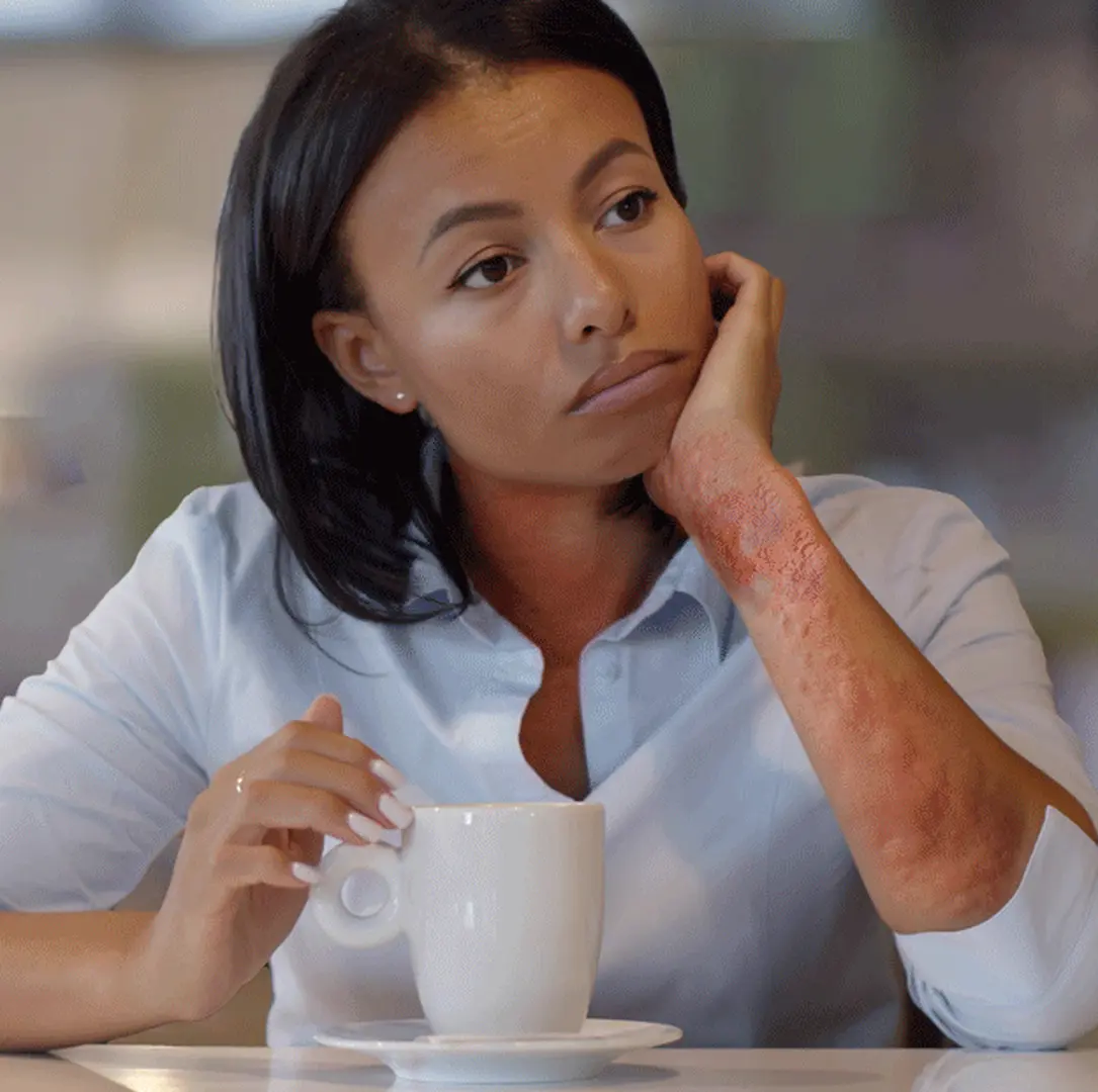 Woman with hives on her arm